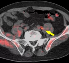 prostate cancer PET/CT