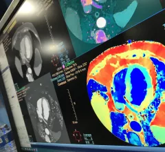 A spectral CT image of the heart showing ischemia in the myocardium by mapping the iodine density in the tissues as a surrogate for bloodflow. Example is from Philips Healthcare, displayed at the 2022 ACC meeting. Example of cardiac perfusion imaging. #SCCT