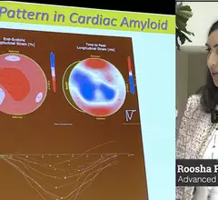 Roosha Parikh, MD, advanced imaging cardiologist, St. Francis Heart Hospital, Long Island, New York, and a clinical assistant professor of medicine at the State University of New York at Stony Brook, presented in one of the ASE 2023 amyloid sessions and spoke with Cardiovascular Business about the disease. Example of cardiac ultrasound strain imaging for cardiac amyloidosis. 