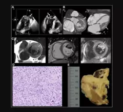 “Undifferentiated Cardiac Sarcoma of the Mitral Valve: Multimodal Imaging Assessment" Radiology: Cardiothoracic Imaging RSNA 