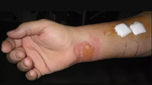 Example of a RF burn from an MRI scan where a sedated patient's identification bracelet was touching their skin during an exam. Image courtesy of RSNA. https://pubs.rsna.org/doi/10.1148/radiol.09090637