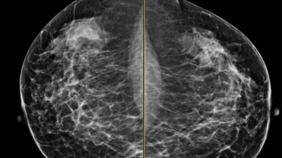 Example of a mammogram showing X-ray images of both the right and left breast and patches of dense breast tissue.