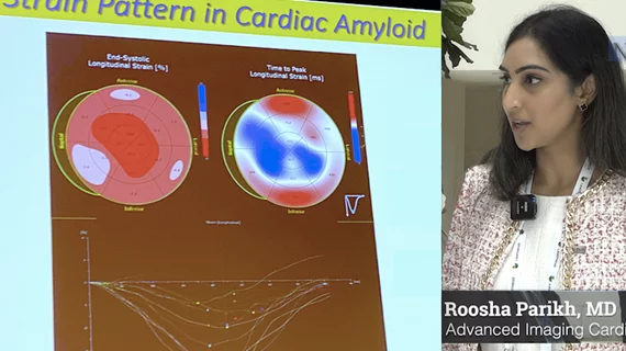 Roosha Parikh, MD, advanced imaging cardiologist, St. Francis Heart Hospital, Long Island, New York, and a clinical assistant professor of medicine at the State University of New York at Stony Brook, presented in one of the ASE 2023 amyloid sessions and spoke with Cardiovascular Business about the disease. Example of cardiac ultrasound strain imaging for cardiac amyloidosis. 