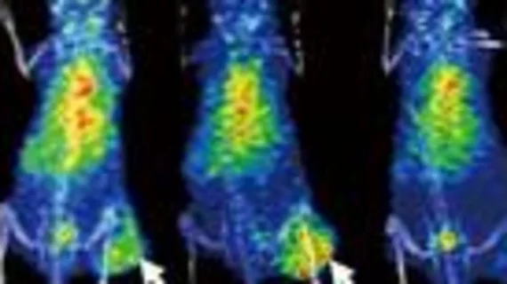 A newly identified PET imaging biomarker could help providers tailor immunotherapy treatments for patients with certain types of cancers. 