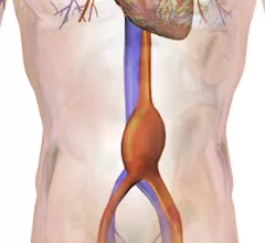 Abdominal aortic aneurysm (AAA)