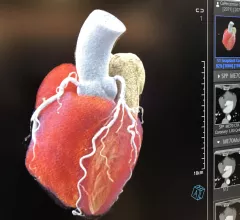 Siemens Healthineers showed examples at ACC 2022 of cardiac computed tomography (CT) from its new Naeotom Alpha photon-counting CT scanner cleared by the FDA in 2021.