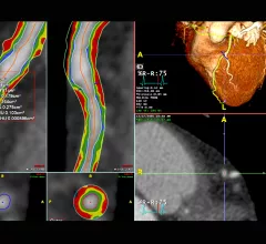 An example of CT imaging coronary plaque assessment on TeraRecon's advanced visualization software.