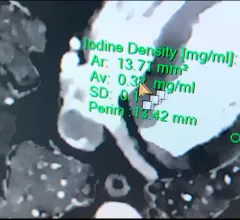 An example of spectral cardiac CT being used to show iodine density in the myocardium to show perfusion deficits. Shown by Philips healthcare at ACC 2022. 