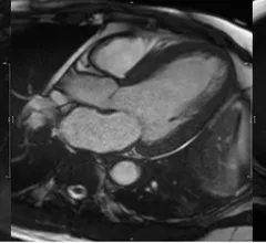CMR of a patient showing evidence of myocardial hypertrophy