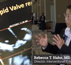 Interview with Rebecca T. Hahn, MD, Professor of Medicine at Columbia University Irving Medical Center, Chief Scientific Officer of the Echo Core Lab at the Cardiovascular Research Foundation and Director of Interventional Echocardiography at the Columbia Structural Heart and Valve Center. She discusses some of the trends of growing use of interventional echocardiographic guidance in transcatheter structural heart procedures, the growing number of tricuspid valve procedures, and use of 3D ICE.
