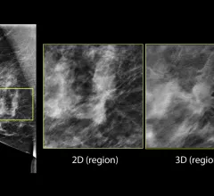 Example of a cancer that is difficult to see in dense breast tissue, but can be seen easier using 3D mammography digital breast tomosynthesis (DBT) breast imaging because the radiologist can go through the breast layer by layer if tissue..