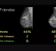 An example of commercially available artificial intelligence (AI) automated grading of breast density on mammograms from the vendor Densitas.. 