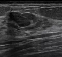 lesion on breast ultrasound