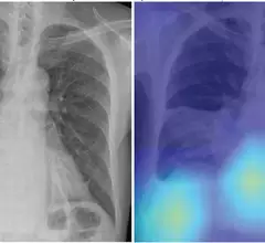 A figure from the study shows a chest radiograph with an area of consolidation involving right lower lung consistent with pneumonia, as well as right pleural effusion. The deep-learning model predicted risk of 30-day mortality of 9%. Right: Gradient- weighted class activation map shows that model prediction was influenced by separate area of image corresponding with heart and liver (yellow and light blue colors). Patient’s CURB-65 score was 4. Patient recovered from pneumonia and remained alive. AJR Image