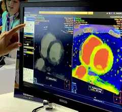 Example of cardiac CT and how spectral imaging assessment of the scan and show areas myocarditis as part of a demo in the Philips booth at RSNA 2023. Cardiac CT took center stage in all of the large CT vendors this year at RSNA and four new CT scanners where introduced, all of which were being promoted for their cardiac imaging capabilities. Photo by Dave Fornell #RSNA #YesCCT #RSNA23 #RSNA2023