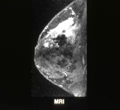 Breast MRI imaging