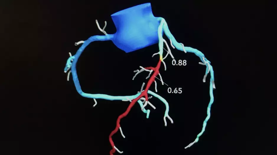 Performing CT-derived fractional flow reserve (CT-FFR) before transcatheter aortic valve replacement (TAVR) improves the accuracy of coronary CT angiography (CCTA) and helps limit unneeded invasive coronary angiography (ICA), according to a new study published in JACC: Cardiovascular Interventions. Heartflow
