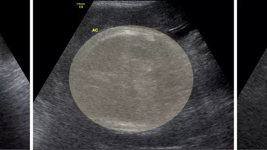 fetal weight measurements ultrasound