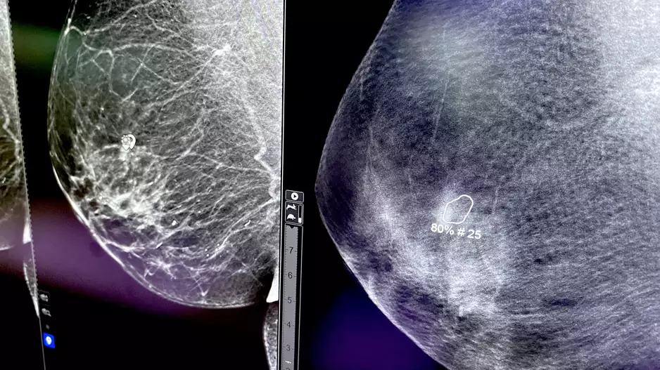 GE HealthCare Breast Cancer AI
