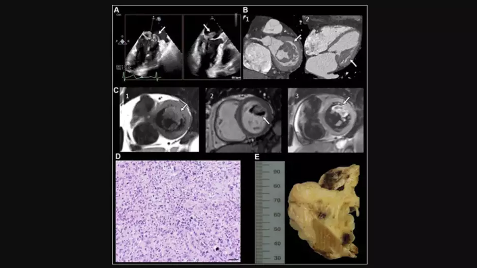 “Undifferentiated Cardiac Sarcoma of the Mitral Valve: Multimodal Imaging Assessment" Radiology: Cardiothoracic Imaging RSNA 