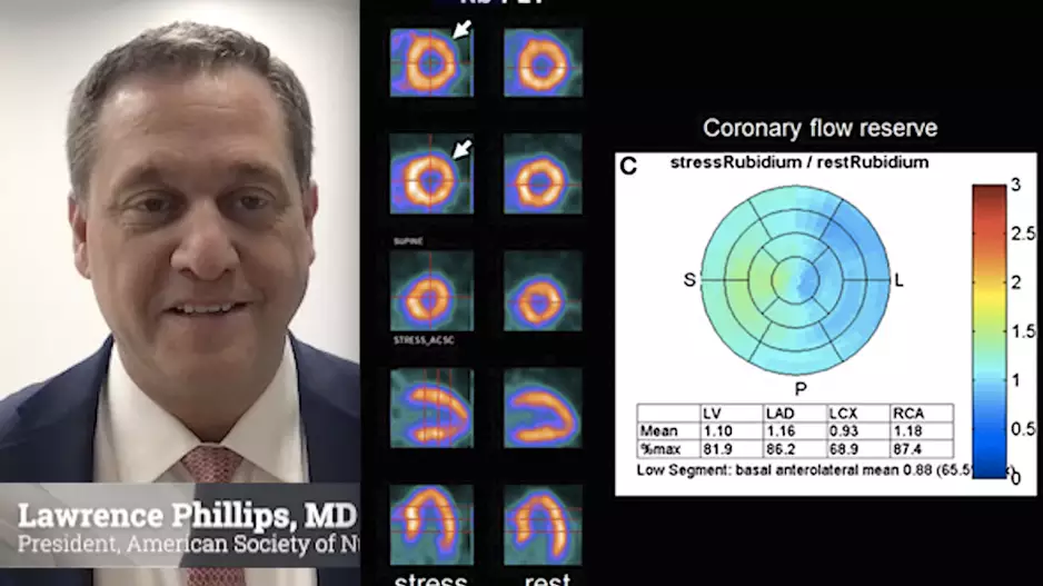 Video interview with ASNC President Lawrence Phillips, MD, NYU, who is encouraging the modernization of nuclear cardiology labs and expansion into new diagnostic areas.