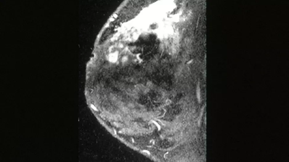Breast MRI imaging