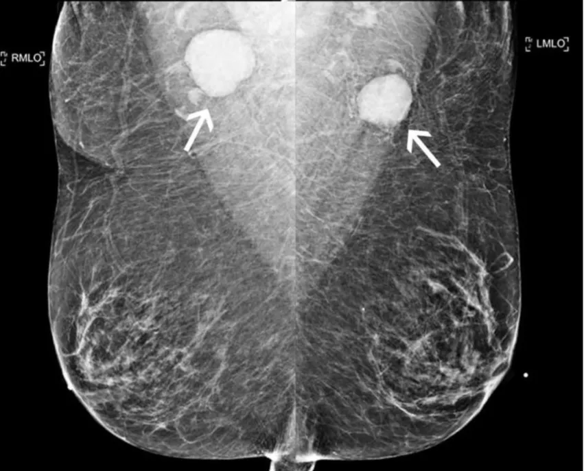 Do not delay getting a mammogram with the COVID Vaccine. Don't delay getting breast imaging. Mammography imaging showing axillary adenopathy caused by COVID-19 vaccination. The swollen lymph nodes can mimic cancer. A new study suggests women should not delay screening because of the issue. Image courtesy of RSNA