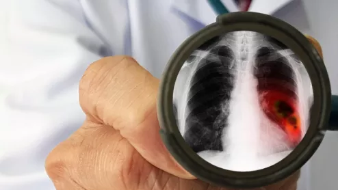lung cancer pulmonary nodule chest