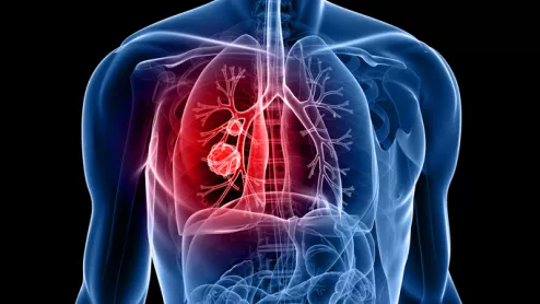 lung cancer pulmonary nodule