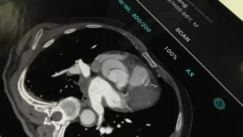 An example of the Aidoc alert via smartphone for an AI-detected, suspected aortic dissection. The AI alerts acute care team members automatically after the AI reviews the scans from the CT system before they are viewed by a radiologist to help speed response times.