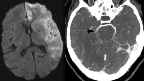 Ischemic stroke CT imaging. Images courtesy of RSNA