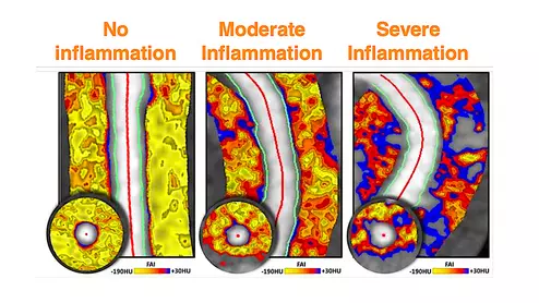Fat attenuation index (FAI) CT imaging of coronary artery fat can show inflammation and can help pin-point vulnerable plaques, or show the reversal of inflammation due to drug therapies. The technology is being developed by the vendor Caristo, which has European CE mark and the company is seeking FDA clearance. #SCCT #SCCT2022
