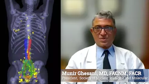 Munir Ghesani, MD, SNMMI president, explained the impact of PSMA-PET imaging on nuclear image and treatment for prostate cancer.