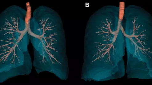 Radiology study compares the lungs of a female and male non-smoker