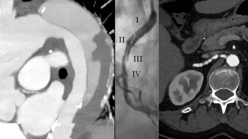 Vascular CT beyond the coronaries includes imaging for aortic aneurism, aortic dissection, SCAD and fibromuscular dysplasia. #SCCT #SCCT2022 #SCAD #yescct 