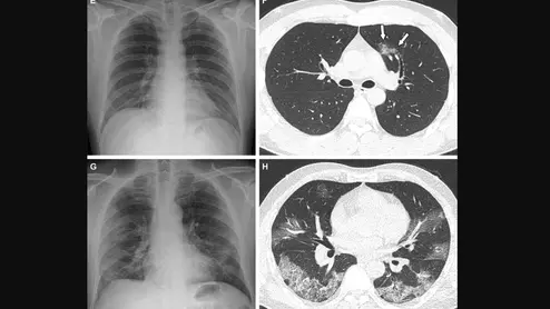 Representative cases showing pneumonia extents and patterns on chest X-ray (CXRs) and CT images. (E and F) A 36-year-old male with no history of vaccination for COVID- 19. The patient had no history of comorbidity. Axial chest CT image obtained on the same day showing unilateral ground-glass opacity with a nonrounded morphology and non-peripheral distribution in the left upper lobe (arrows). RSNA Image. COVID on X-ray, CT scan. What does COVID look like in medical imaging? Example of COVID imaging.