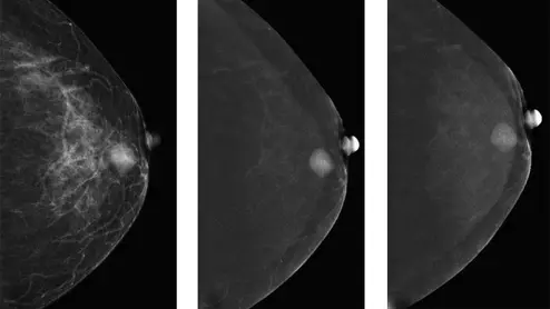 contrast enhanced mammography