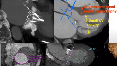 Examples of structural heart transcatheter valve replacement procedure planning CT scans and post procedure followup for TMVR and TAVR. 