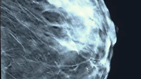 A slice from a tomosynthesis 3D mammography mammogram. Image courtesy of Mass General