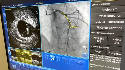 IVUS with coregistration with angiography displayed by Philips at TCT 2023. Photo by Dave Fornell