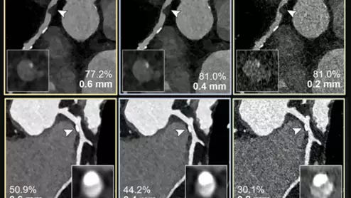 Examples of photon-counting coronary angiography showing how clarity improves as the thickness of the image is reduced. Top: 60-year-old female, with noncalcified plaque (arrowheads) and coronary stenosis (inset images). The reduced section thickness did not affect assessment in this patient. Bottom: 56-year-old female with calcified plaque (arrowheads) and coronary stenosis. The reduced section thickness leads to less calcium blooming and therefore a less severe percentage of stenosis. Courtesy of RSNA