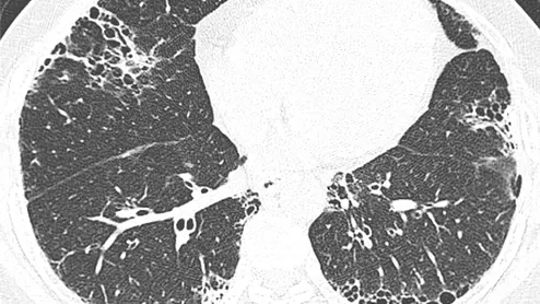 A study published this week in Radiology found that 12 months after hospitalization for COVID pneumonia, 93% of patients’ lung abnormalities had cleared up on follow-up chest CT scans.#covidpneumonia #groundglassopacities