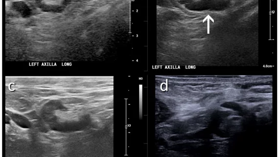 Don't delay mammograms after COVID vaccine. Women do not need to delay their mammogram appointment after COVID-19 vaccination. An example of COVID vaccine caused axillary adenopathy. The woman has a family history of breast cancer, but this lesion, seen on breast ultrasound, tested negative in an RSNA study. Women should not wait to get a mammograms after COVID vaccines.