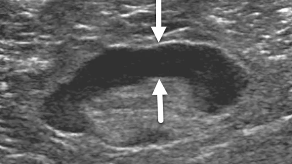 Breast ultrasound of a 62-year-old woman with benign reactive adenopathy after COVID-19 vaccination. Image from Academic Radiology. 