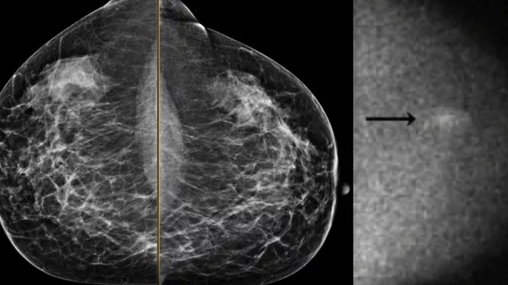 An example of a mammogram with some dense breast tissue that was deemed to not have cancer, and molecular breast imaging (MBI) study of the same women showing increased metabolic activity in the dense area, revealing a caner. Image from Mayo Clinic.