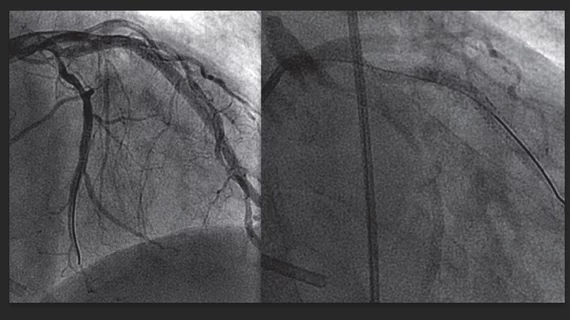 A comparison between a traditional iodine contrast angiogram (left), and a gadolinium contrast angiogram (right). MRI gadolinium contrast is starting to be used in some interventional radiology procedures and is being considered in interventional cardiology due to the iodine contrast shortage.