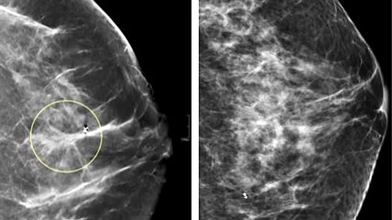 Comparison of a 2D digital mammogram and breast tomosynthesis 3D mammography showing ability to better evaluate details in areas of dense breast tissue. Photo from UCSF.