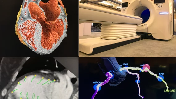 Examples of new cardiac CT technologies at the 2022 SCCT meeting. Top left clockwise, realistic 3D rendering inside the heart, the GE Revolution Apex scanner, Cleerly's AI automated soft plaque assessment, and CT strain imaging from Medis. #SCCT #SCCT2022 #YesCCT #CTA #CCTA, new computed tomography technology