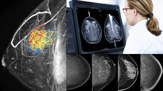 Examples of breast imaging. What does breast imaging look like? What does breast cancer look like? What do radiologists look for on mammograms?
