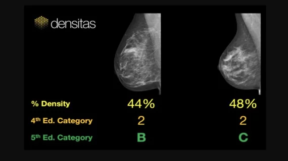 An example of commercially available artificial intelligence (AI) automated grading of breast density on mammograms from the vendor Densitas.. 